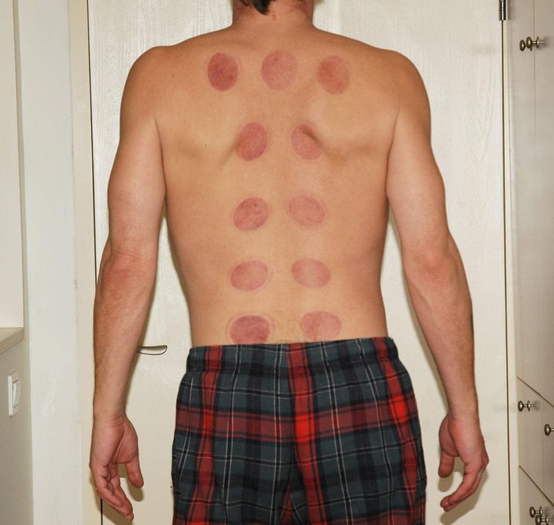 Acupuncture Therapy